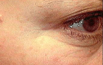 cosmetic injections to get rid of crows feet after picture