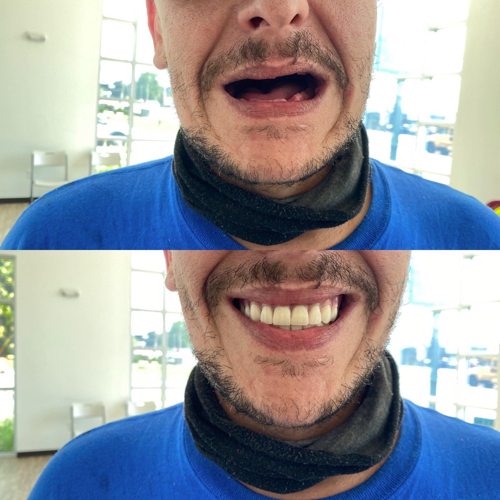 Dentures in Louisville Advanced Dental Center