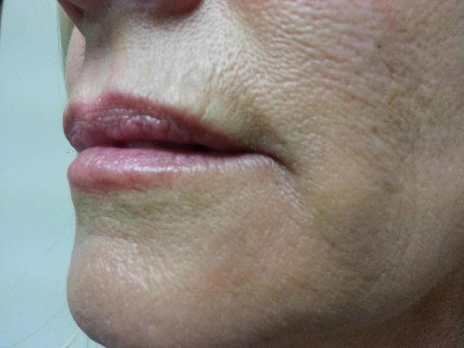 cosmetic injections to get rid of frown lines after picture