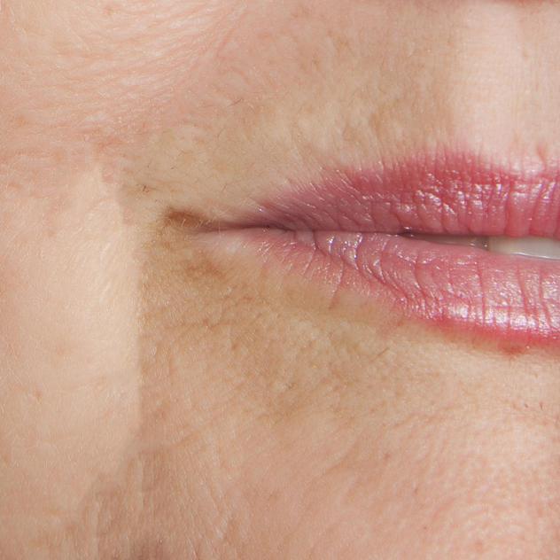 cosmetic injections to get rid of wrinkles after picture