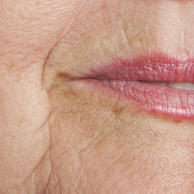 cosmetic injections to get rid of wrinkles before picture