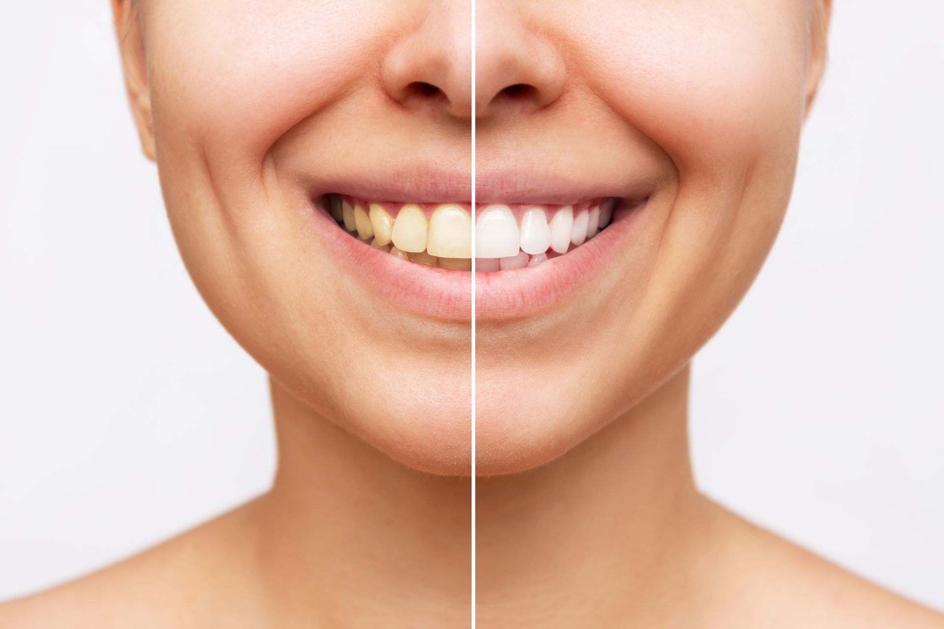 Brighten Your Smile: The Magic of Teeth Whitening at Advanced Dental Center in Louisville, KY