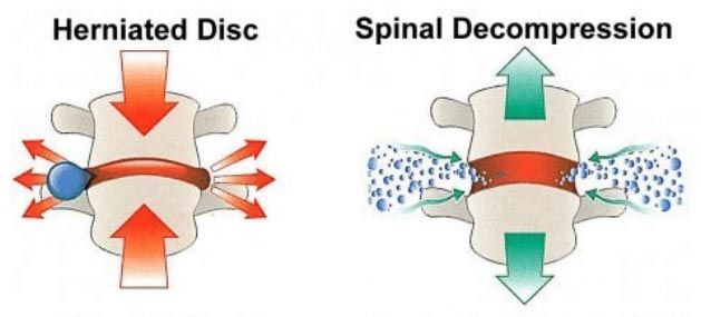 Spine Diagram — Hawley, PA — Pocono Chiropractic Clinic
