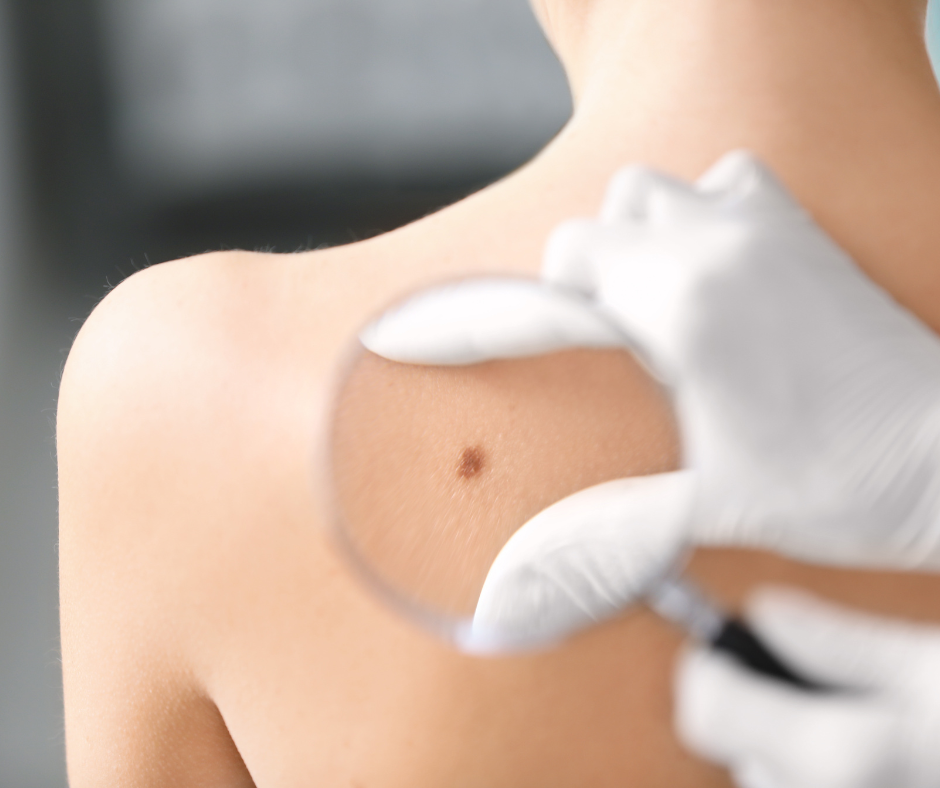 Skin Biopsy & Excisions