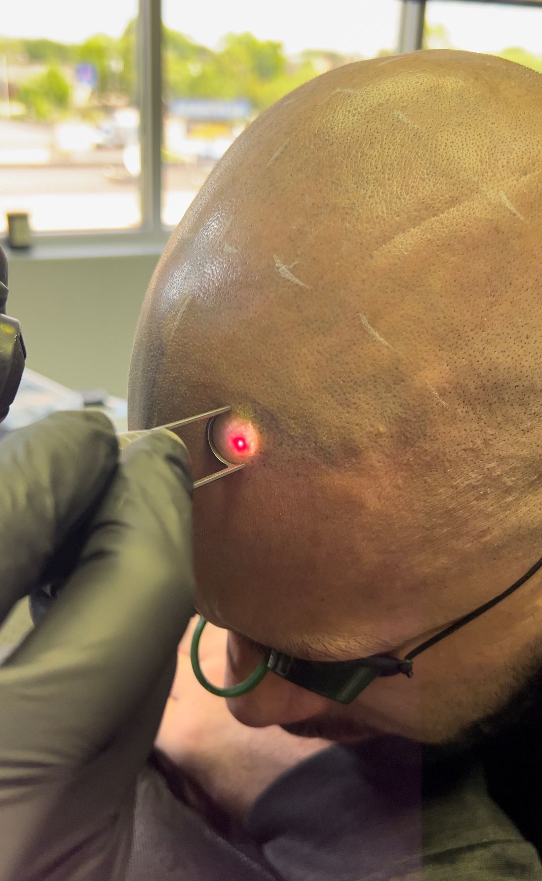 A woman is getting a laser treatment on her forehead.