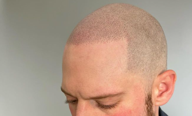 A man with a beard and shaved head has a red cheek