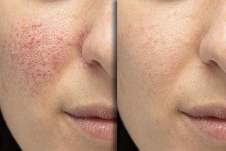 Before and After image of acne scars on face after treatment