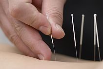 Inserting acupuncture needle