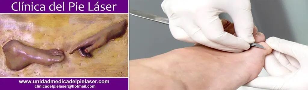 CLÍNICA DEL PIE LÁSER