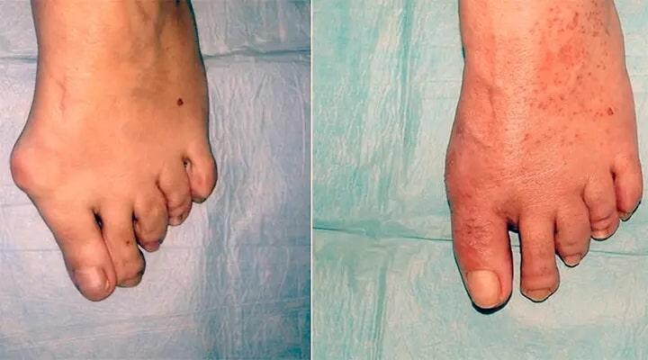 CLÍNICA DEL PIE LÁSER