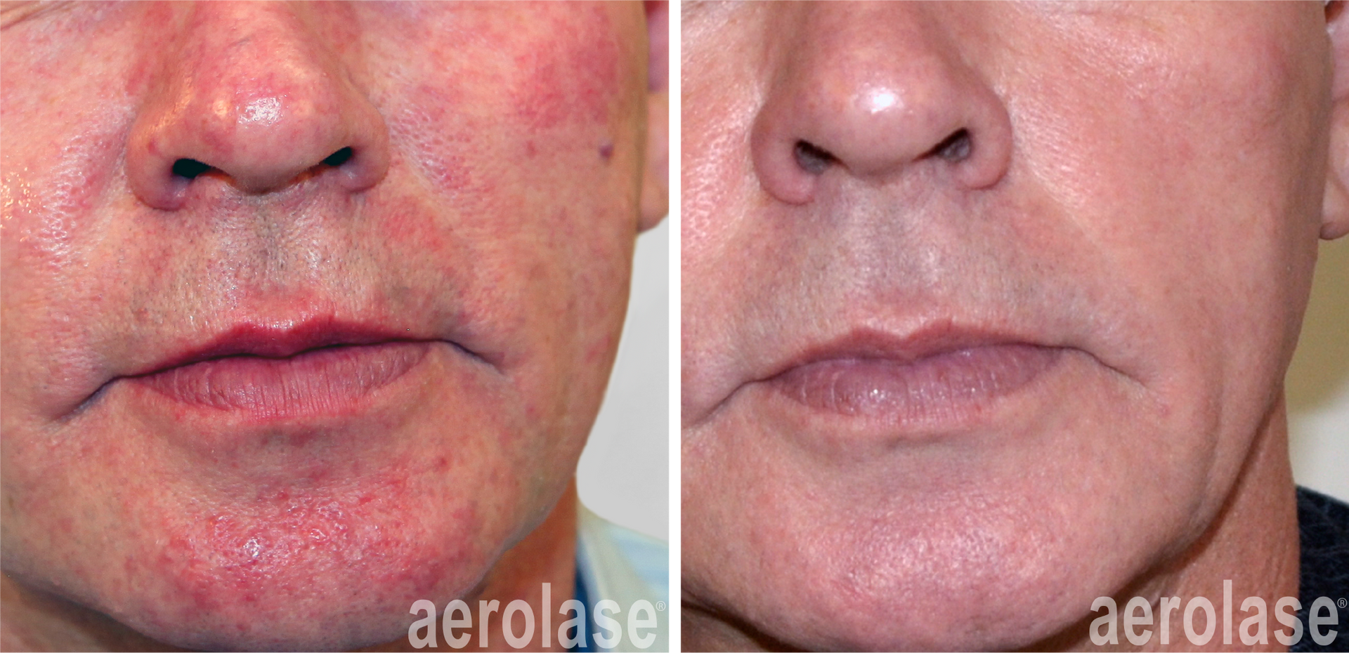 Rosacea, Redness, and Veins — Greenwood, IN — Vigor Health and Beauty