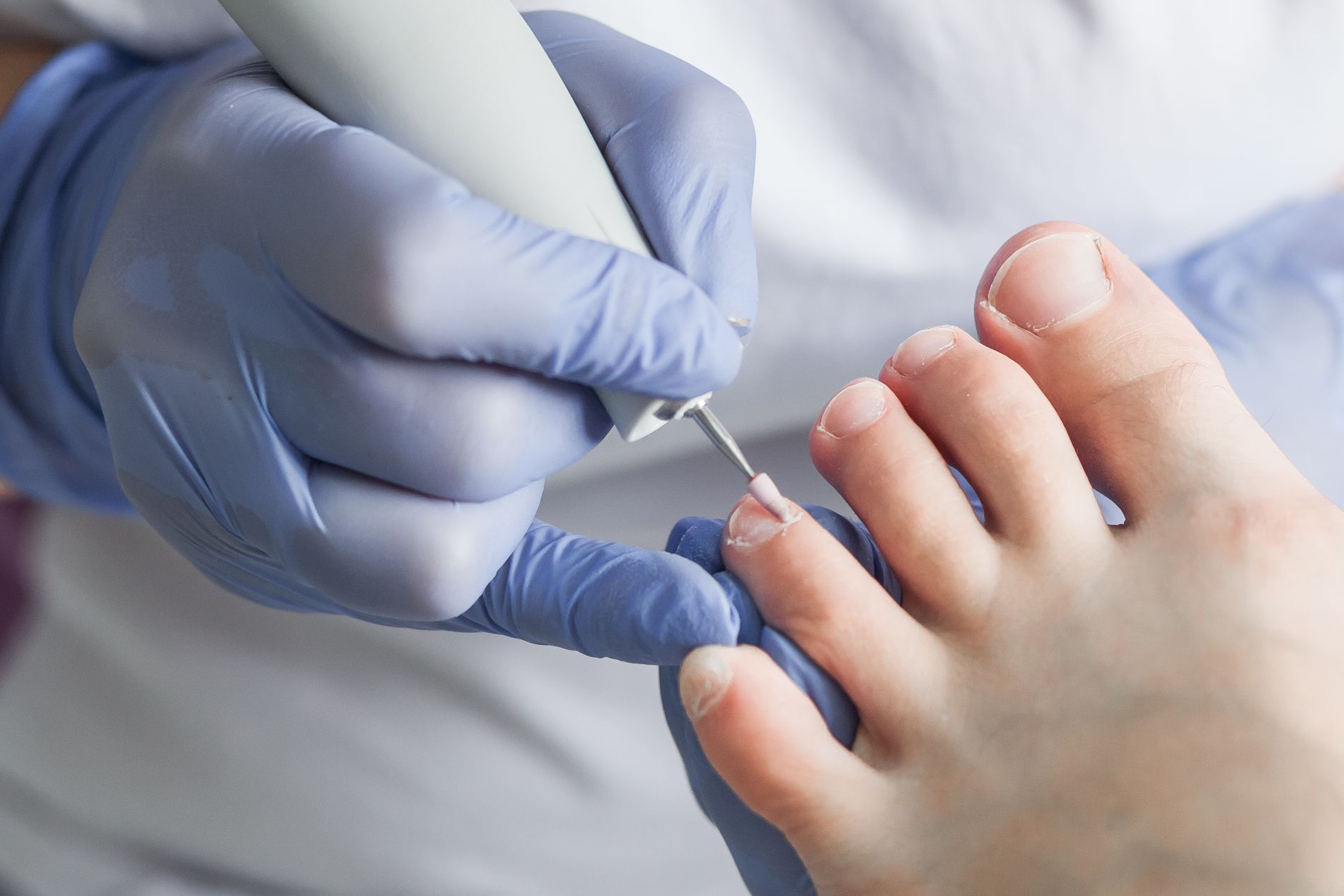 A person is getting their toenails done by a podiatrist.