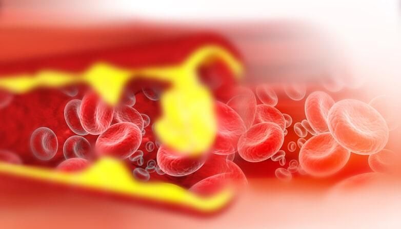 DR. JUAN MANUEL ROSALES JIMÉNEZ - Aneurismas