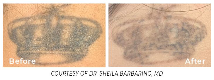 Before and after laser tattoo removal available at Main Street Med Spa