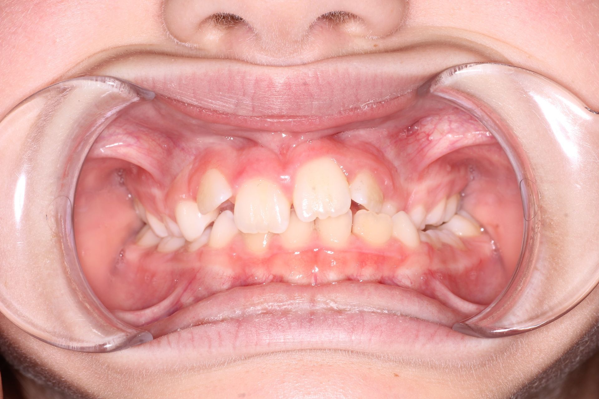 a close up of a person 's teeth with a missing tooth