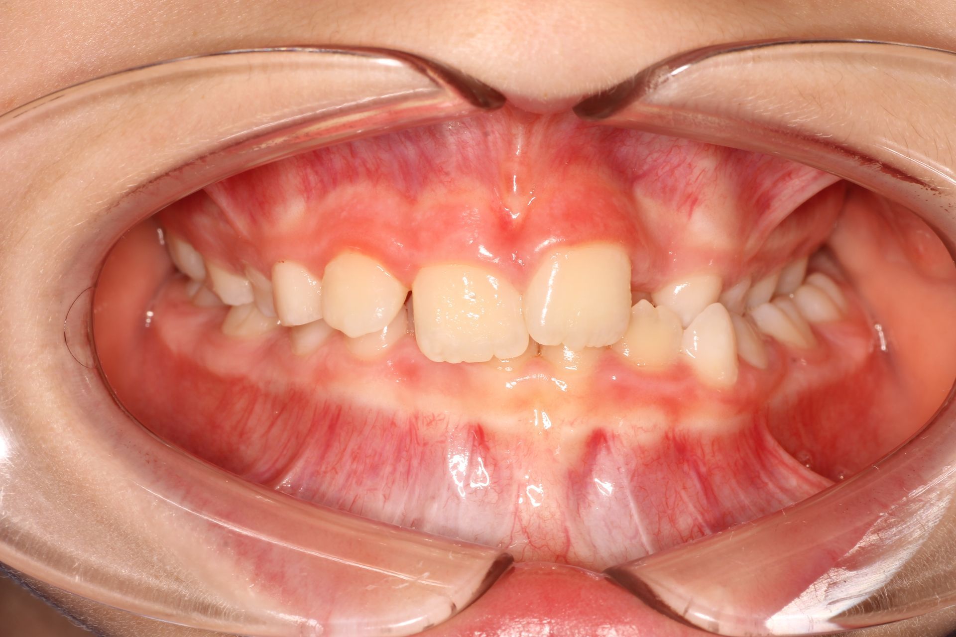 a close up of a person 's teeth with a missing tooth