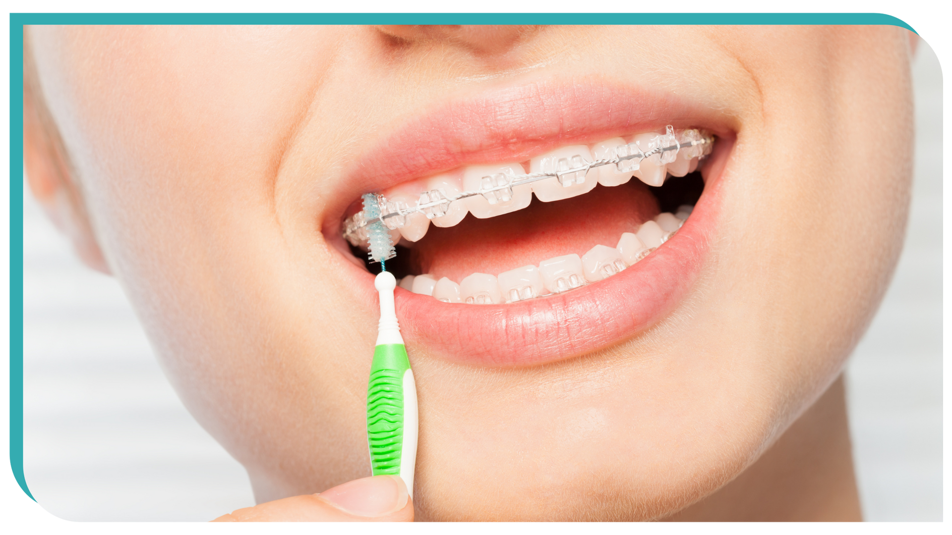 A woman with braces is brushing her teeth with an interdental brush.