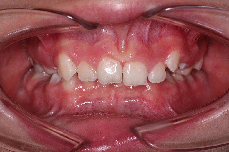 a close up of a person 's teeth with a missing tooth