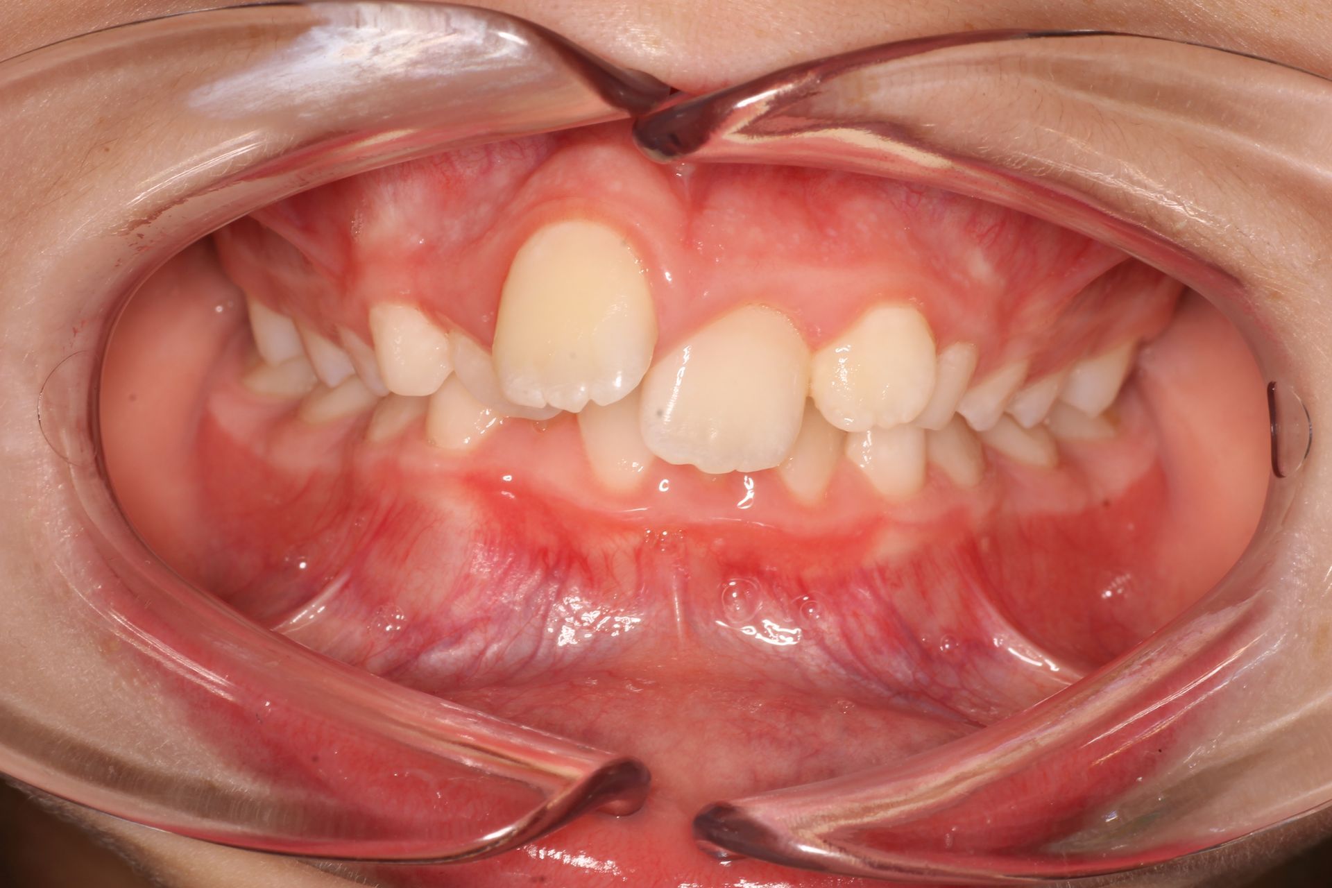 a close up of a person 's teeth with a missing tooth