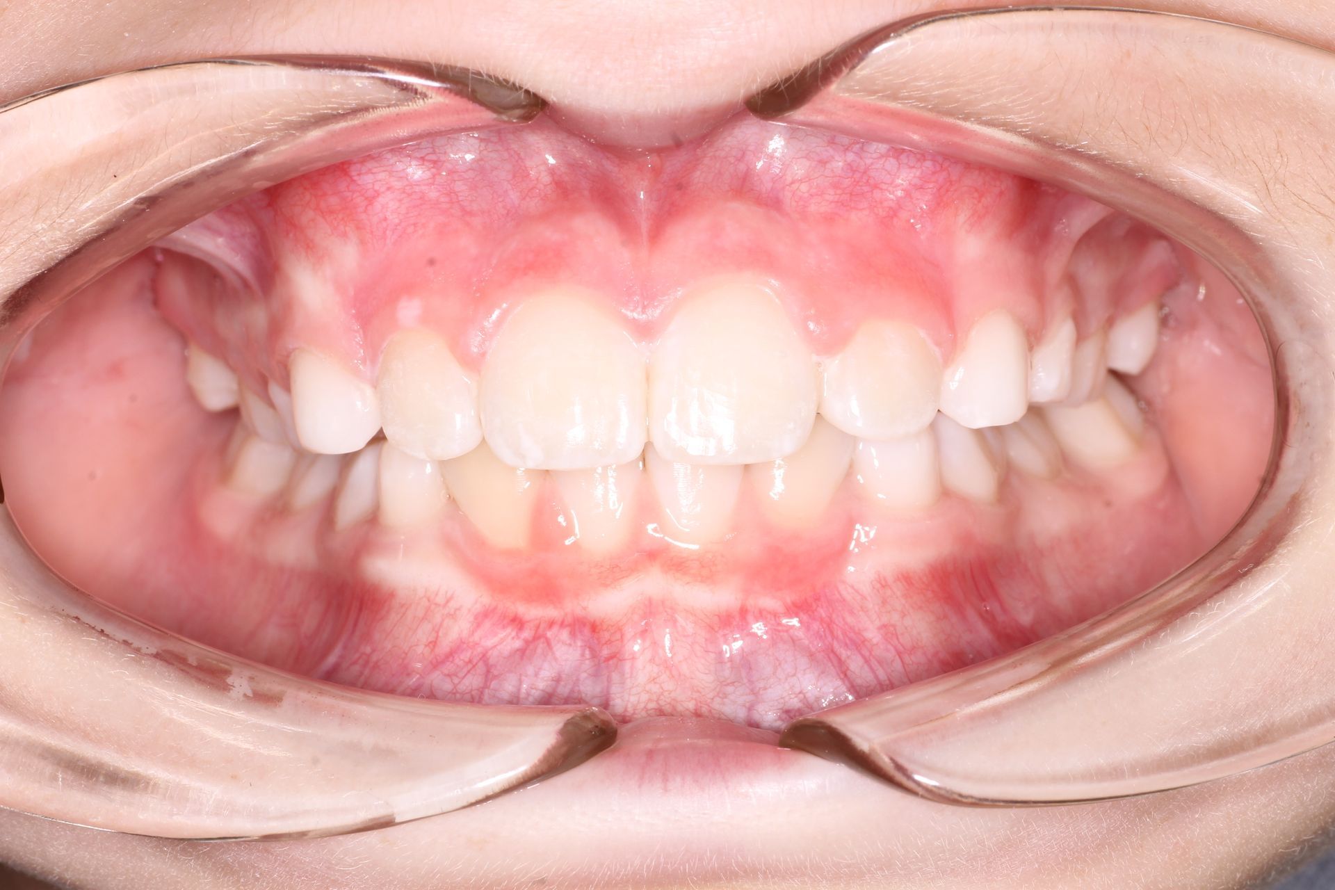 a close up of a person 's teeth with a missing tooth