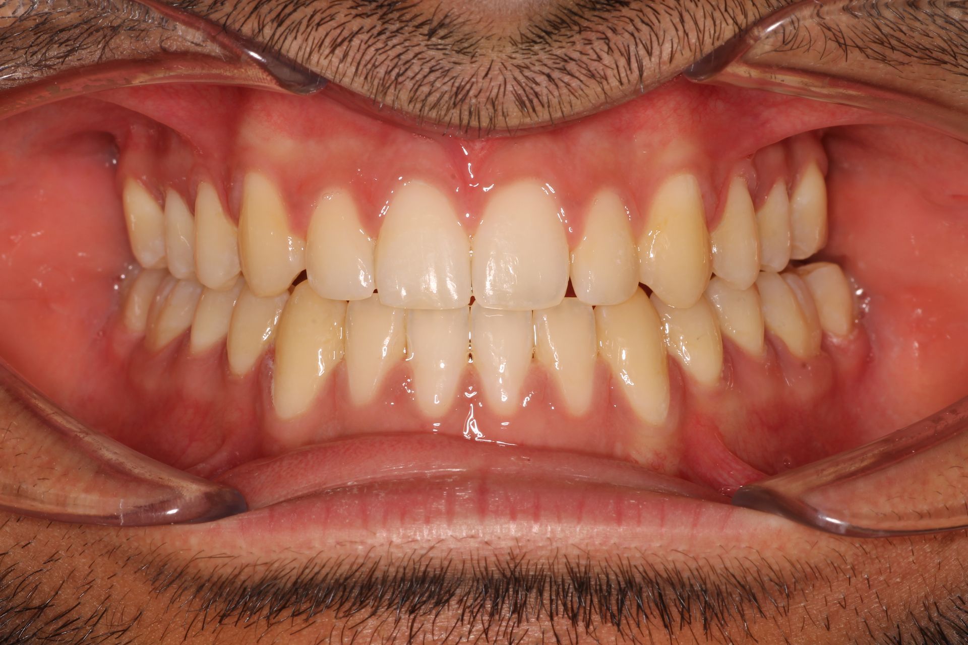 a close up of a person 's teeth with a missing tooth