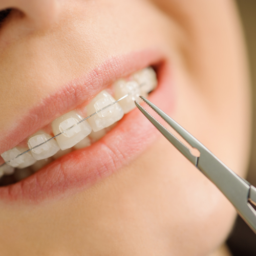a close up of a woman 's teeth with braces and a pair of tweezers .