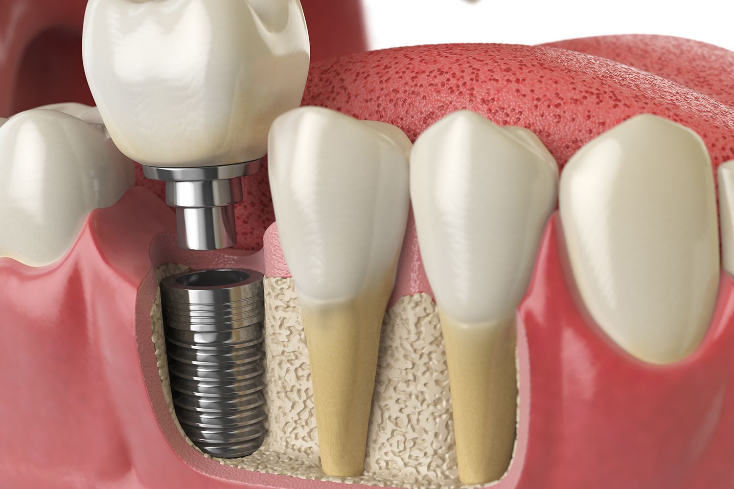 A 3D illustration showing a dental implant with a crown placed in the jawbone next to natural teeth