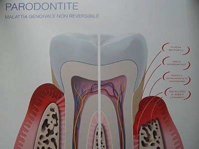 illustrazione della parodontite