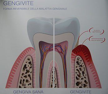 illustrazione di una gengive sana e infiammata