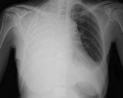 derrame pleural maligno
