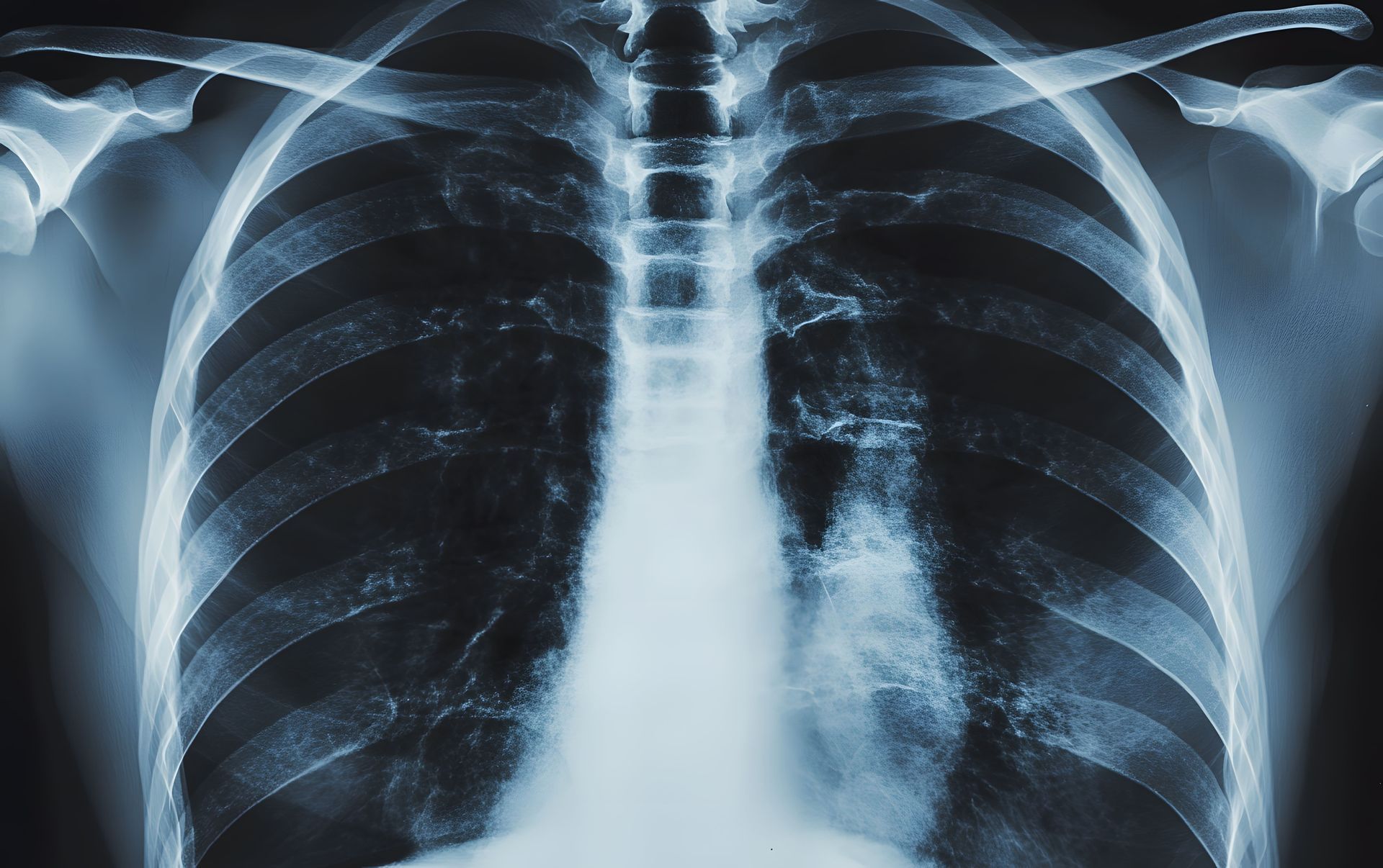 espessamento pleural