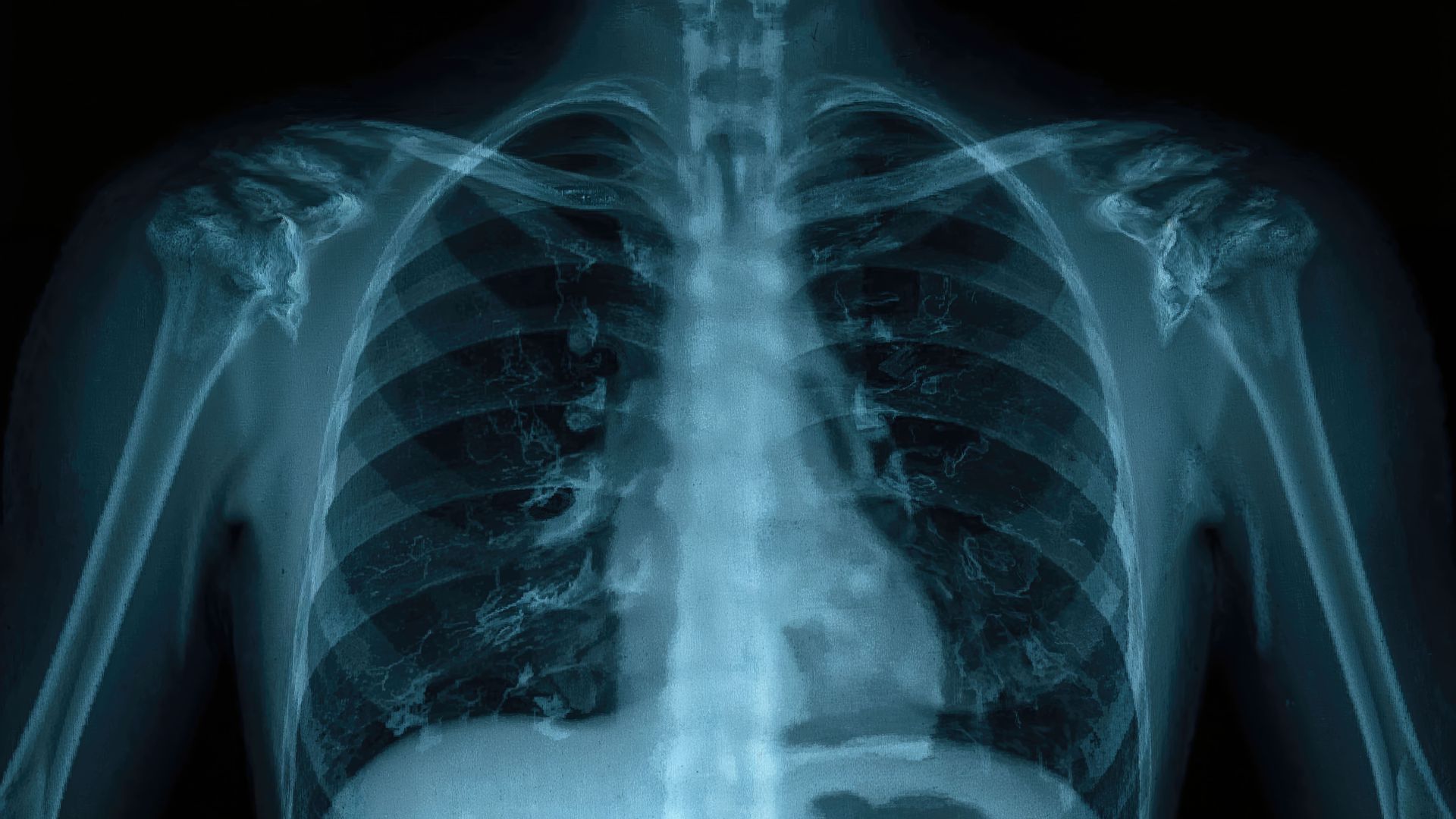 pneumotórax espontâneo