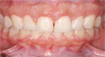 Crown lengthening, esthetic gum contouring after picture