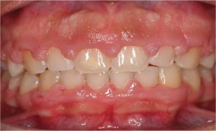 Crown lengthening, esthetic gum contouring before picture