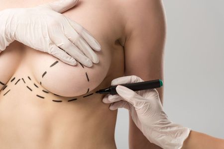 Person's chest marked with dotted lines for surgery; hands in gloves hold a marker.