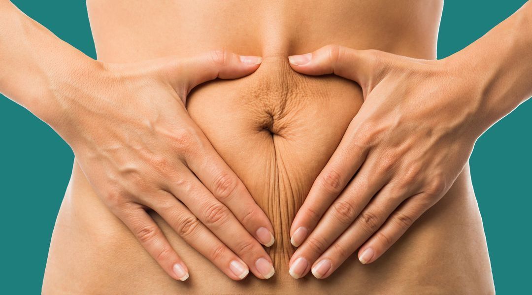 Hands cupped around a person's navel, demonstrating the appearance of loose skin.