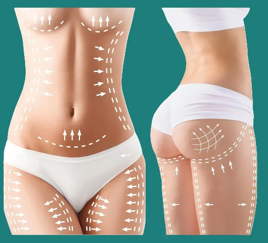 Woman's body with arrows and lines indicating areas for cosmetic procedures on abdomen, thighs, and buttocks.