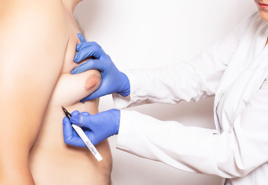 Doctor marking chest of a patient with a pen, wearing blue gloves, white coat.