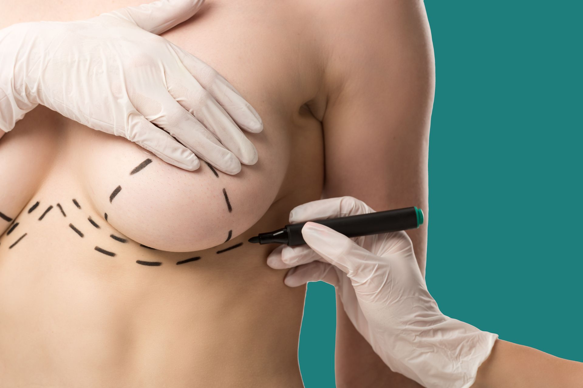 Breast marked with pen, gloved hand, plastic surgery procedure.