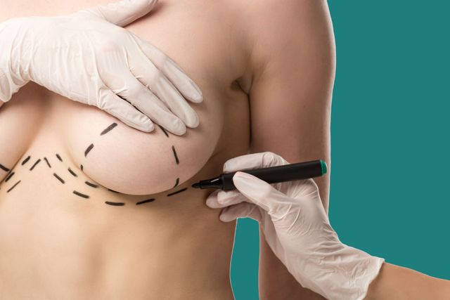 Breast Lift (Mastopexy) | 5280 Plastic Surgery