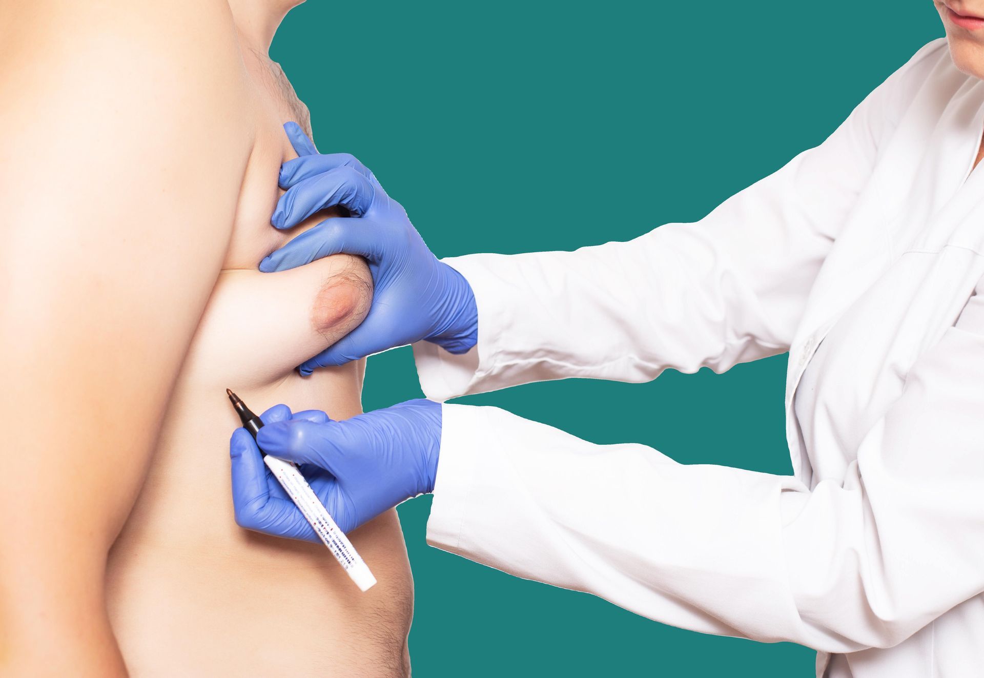 Doctor marking a patient's chest for surgery. Medical professional wearing gloves and a lab coat.