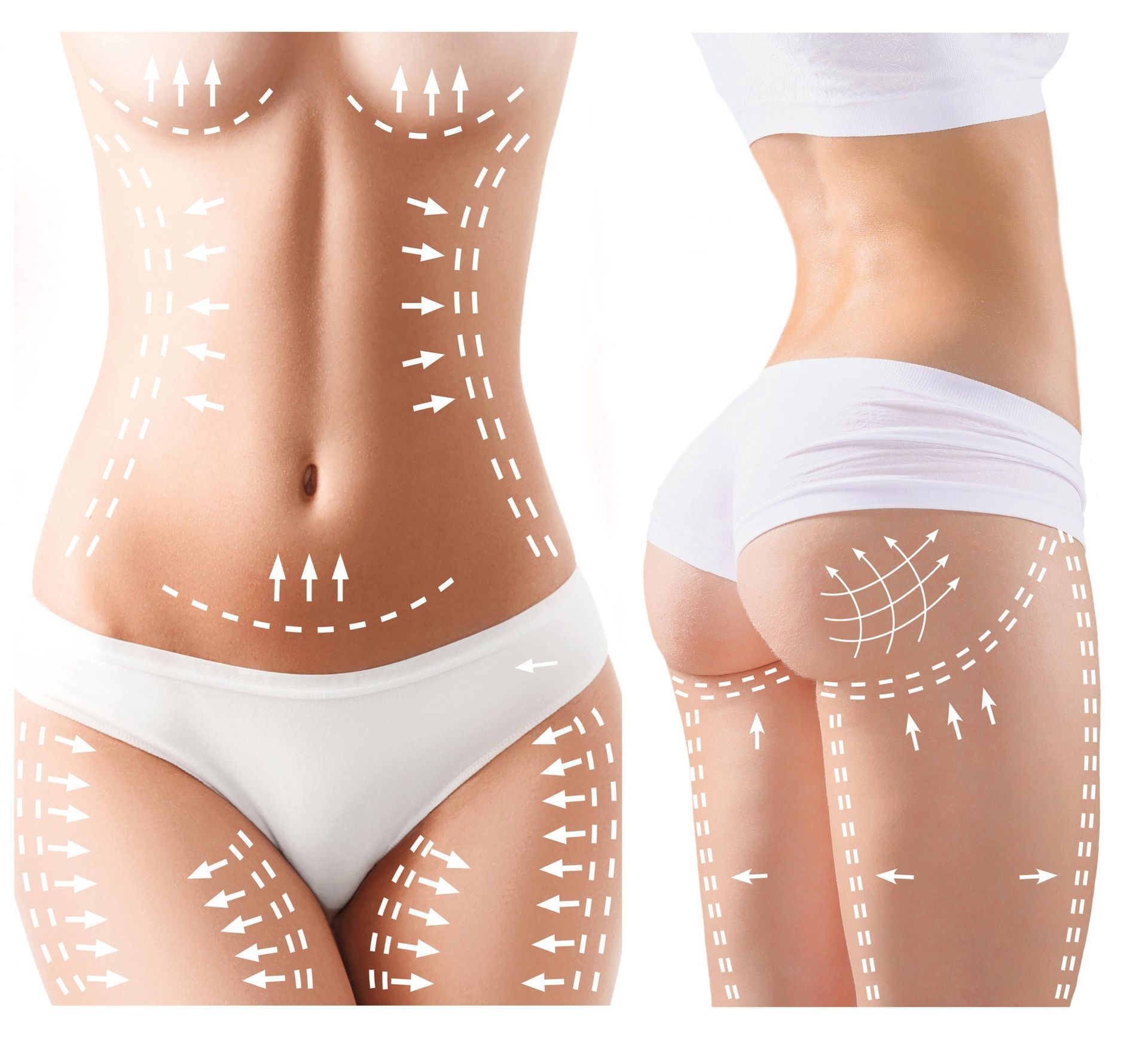 Diagram of a body with arrows indicating areas for cosmetic procedures such as liposuction.