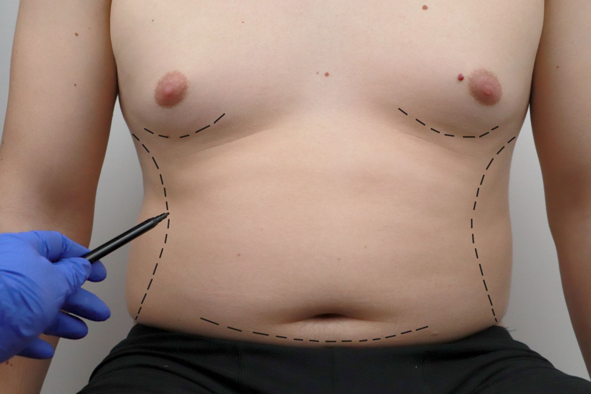 Torso with dashed lines indicating areas for cosmetic surgery; a gloved hand points with a pen.