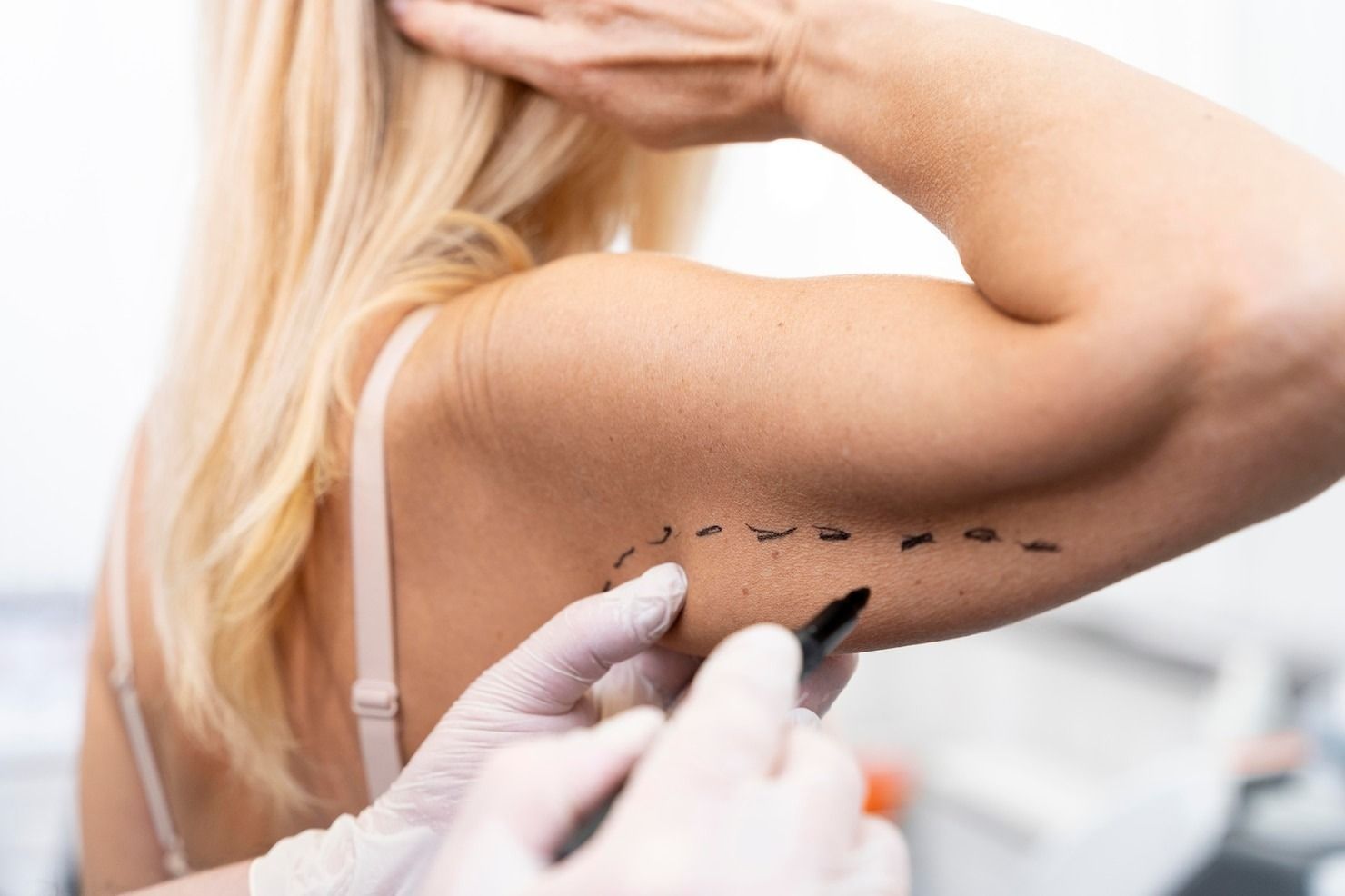 A doctor marking a woman's arm with a pen, preparing for a medical procedure.