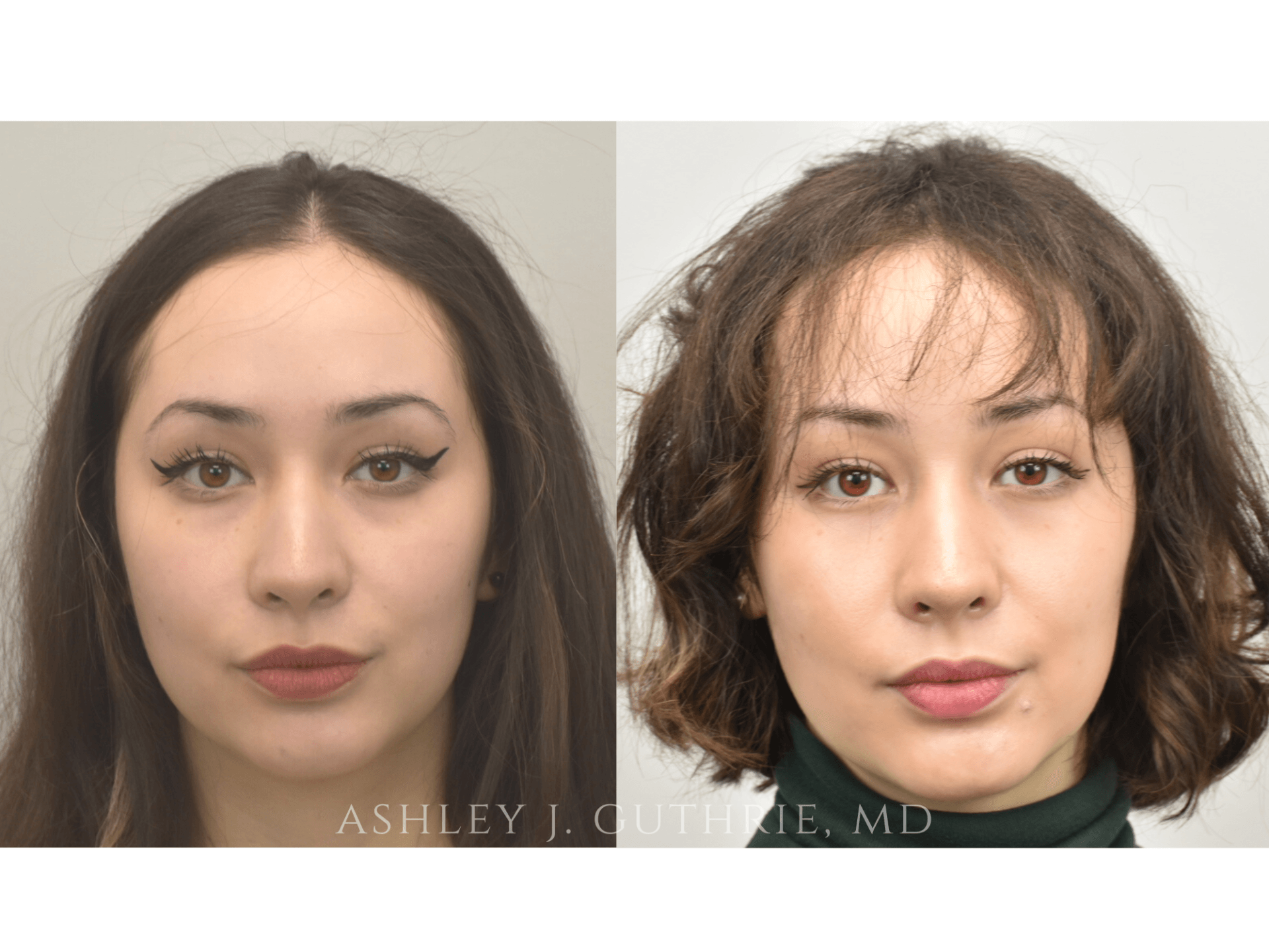 Blepharoplasty - Before and After