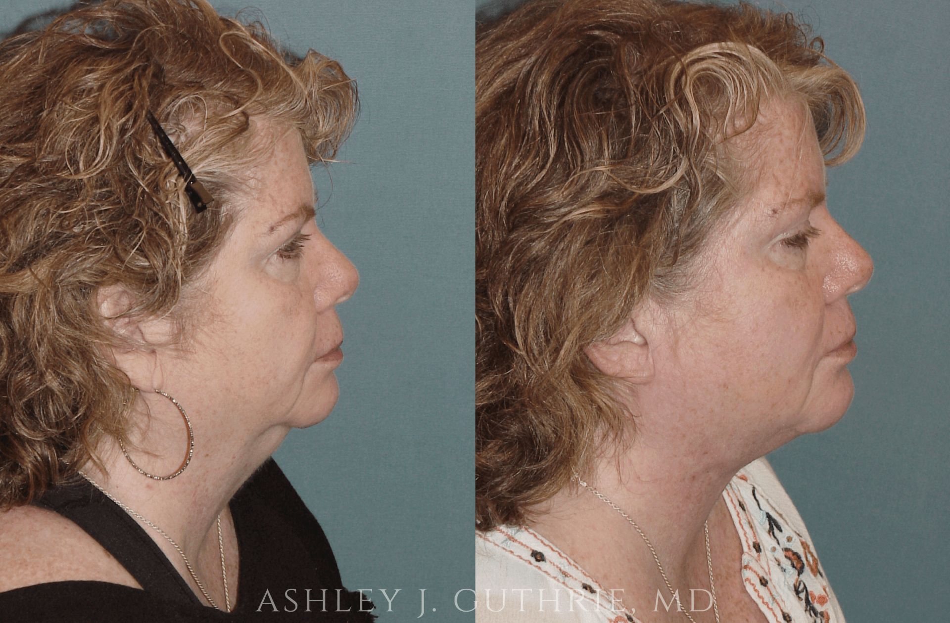 female patient before and after Direct Submental Cervicoplasty and Chin Implant procedures by Dr. Guthrie