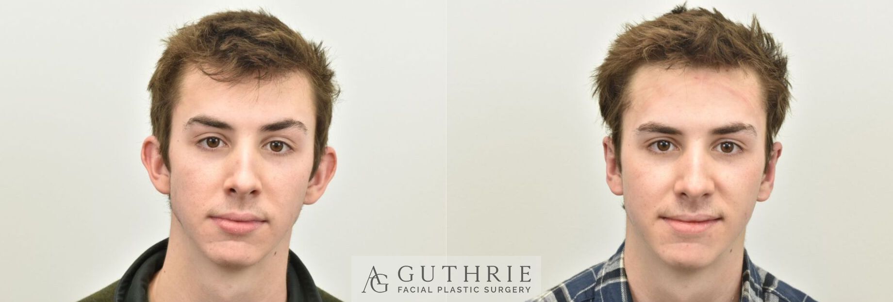 a young man before and after otoplasty surgery