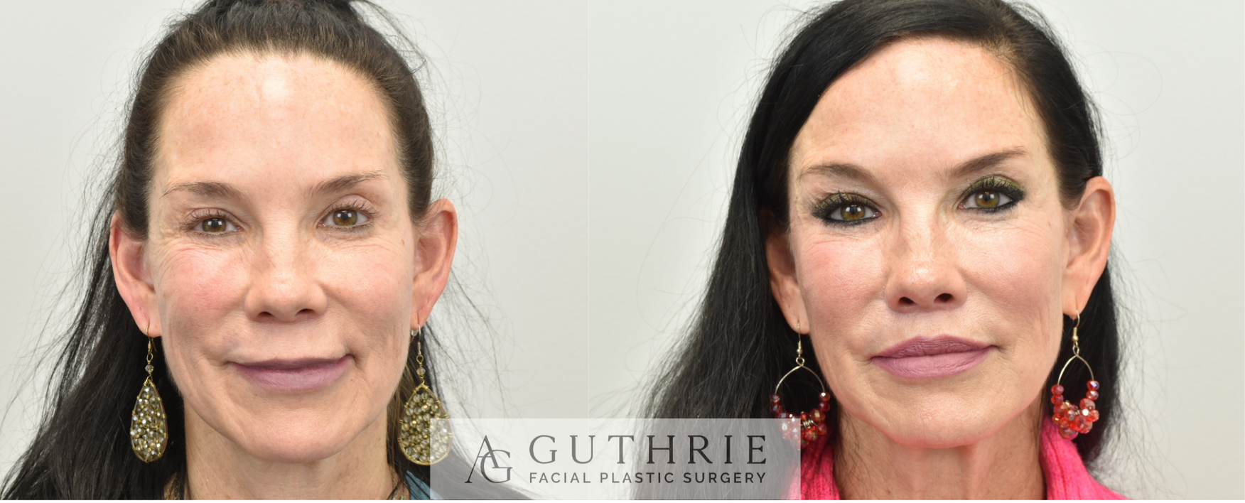 Before and After Subnasal Lip Lift, Upper and Lower Lip Implant Removal