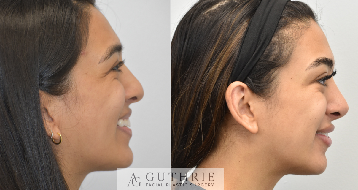 a woman's face before and after rhinoplasty