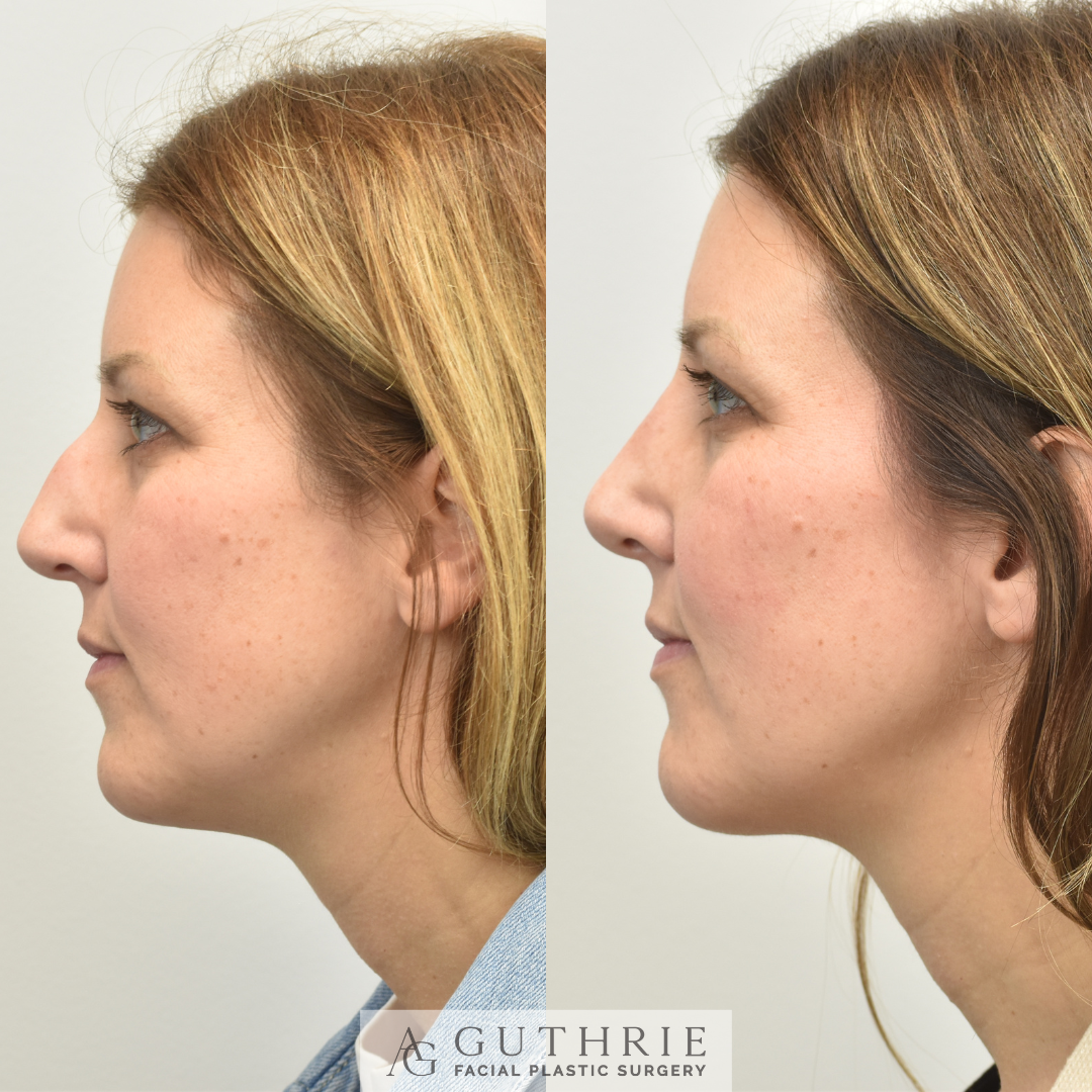 before and after rhinoplasty